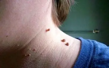 دلایل ایجاد زائده‌های گوشتی و درمان آن