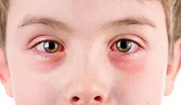 درمورد بیماری التهاب چشم چه می دانید؟