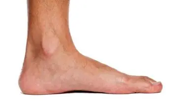 کف پای صاف؛علت و عوارض؟