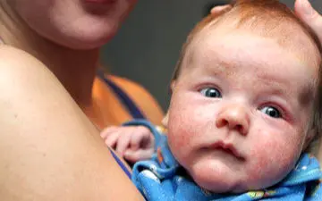 انواع اگزما در نوزادان