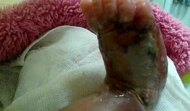 سوختن پای نوزاد در بیمارستان معروف تهران! +عکس
