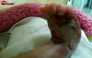 سوختن پای نوزاد در بیمارستان معروف تهران! +عکس