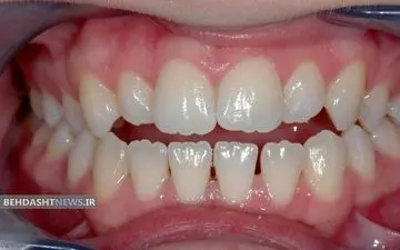  چرا دندان هایمان دندانه دار می شوند؟!