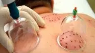 بهترین موقع برای «حجامت» دقیقا چه زمانی است؟