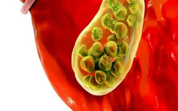 اگر این علائم را دارید شما مبتلا به سنگ صفرا هستید!