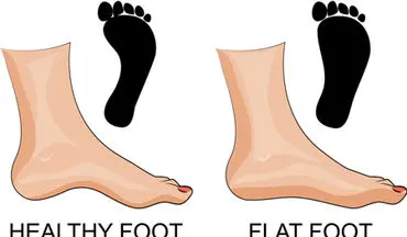  تمرینات فیزیوتراپی و ارتوپدی برای افزایش قوس کف پا و کاهش درد پا