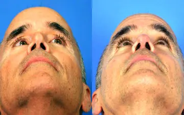 بینی کلیپسی یا بینی منگنه ای چیست؟ 