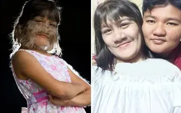  دختر گرگ‌نما ازدواج کرد | تصویری عجیب از صورت این دختر را ببینید