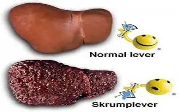 اگر کبدت چرب است و اذیت میشی با این رژیم یک ماهه درمان کنید! 