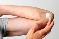 تشخیص اشتباه و مصرف پماد کورتونی، عامل گسترش قارچ پوستی