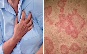 علائم پوستی که نشان از بیماری قلبی دارد
