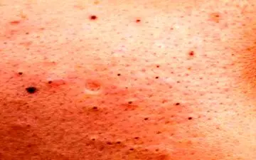 راه‌های ساده و سریع برای از بین بردن جوش سر سیاه