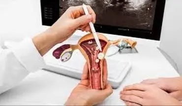 اثرات پولیپ بر باروری و بارداری؟