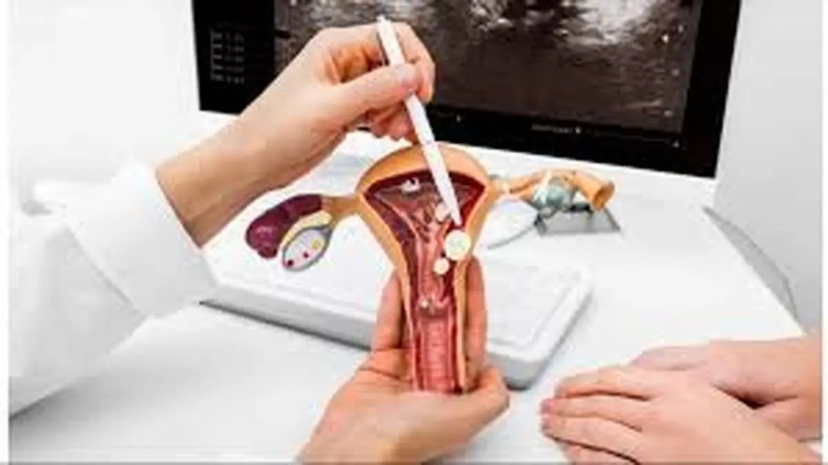 اثرات پولیپ بر باروری و بارداری؟