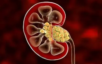 کاهش خطر تشکیل سنگ کلیه 