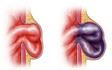 
فتق چیست ؟| انواع فتق و  علائم آن | اگر فتق درمان نشود چه می شود؟ 