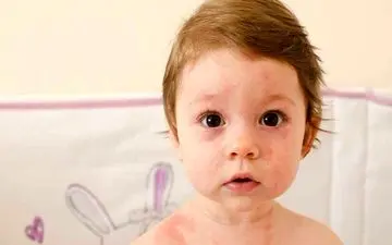 دلایل عرق سوز شدن کودکان و راه‌های پیشگیری از آن 