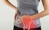 کیست اکوفری در تخمدان راست: چرا ایجاد می‌شود و چگونه درمان می‌شود؟