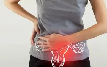 کیست اکوفری در تخمدان راست: چرا ایجاد می‌شود و چگونه درمان می‌شود؟