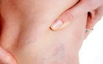 5 راهکار طلایی برای درمان دردهای واریس