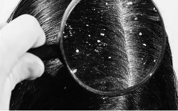 کسانی که از شوره سر خسته شده اند بخوانند!

