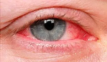 عفونت‌های ویروسی، شایع‌ترین بیماری چشم در فصل گرما