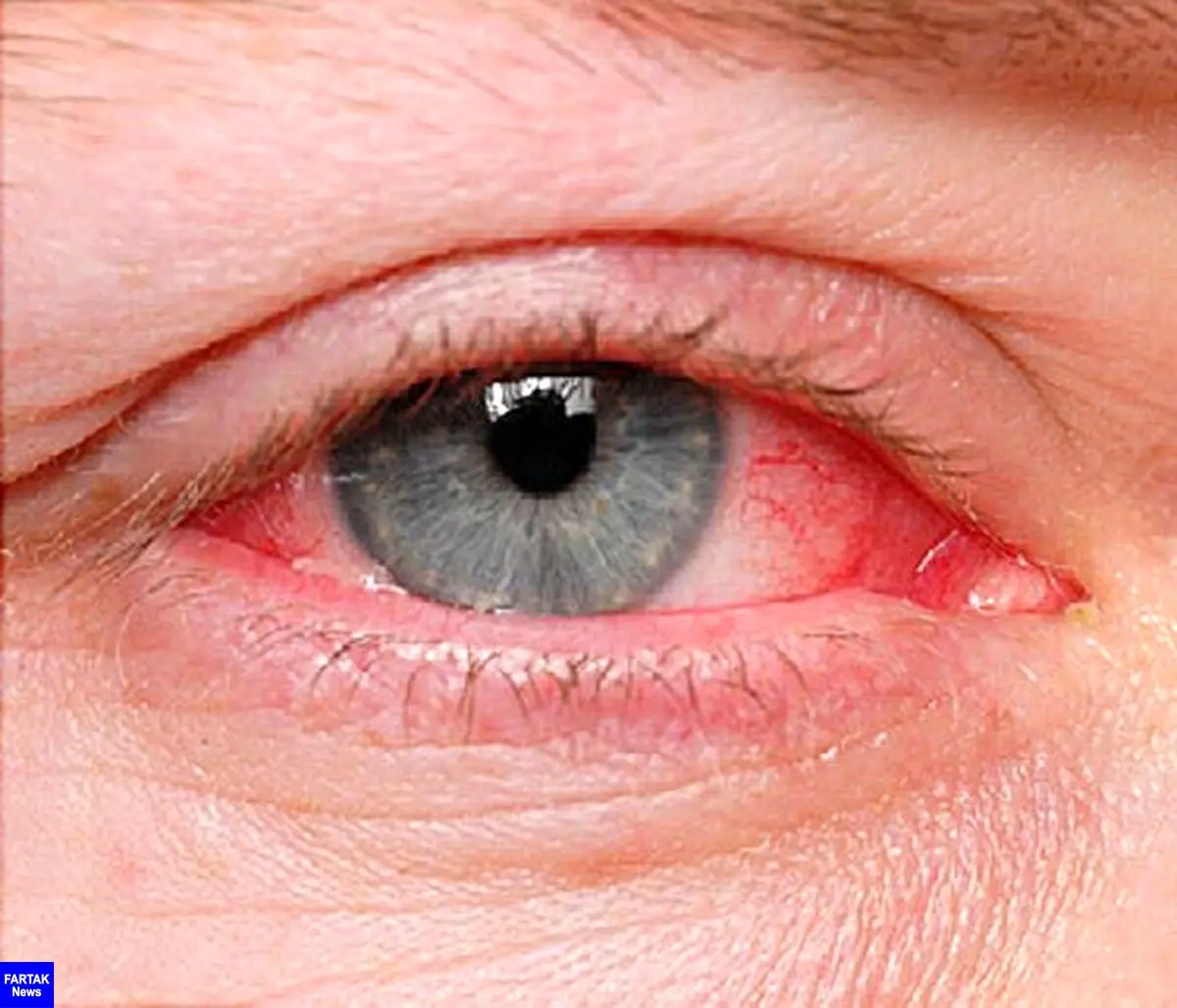 عفونت‌های ویروسی، شایع‌ترین بیماری چشم در فصل گرما