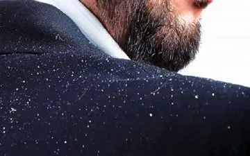 آشنایی با عوامل اصلی شوره سر