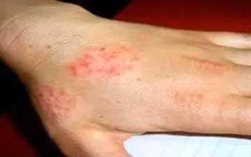  علت و راه های درمان اگزما