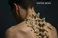 بیماری مرد سنگی؛ وقتی بدن خودش را به قفس تبدیل می‌کند