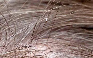 درباره شپش چه می‌دانید؟