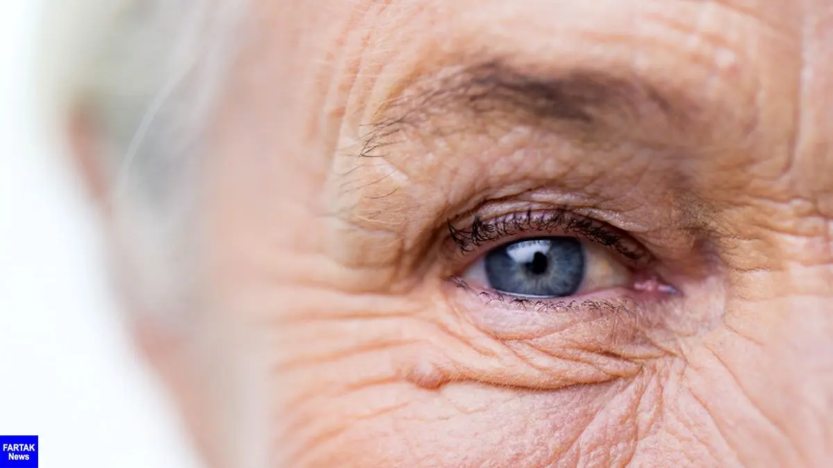شناسایی آلزایمر با تغییرات شبکیه چشم