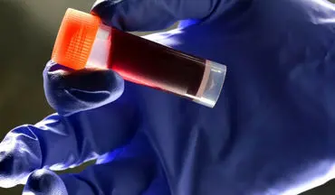  اگر این گروه خونی را دارید بیشتر از بقیه در معرض سکته هستید