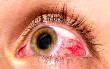 به چند دلیل حتما عینک آفتابی بزنید