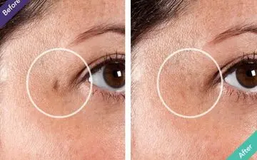 جای آبله مرغان را با این روش ها از بین ببرید