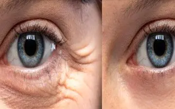 چطور چین‌وچروک‌های گوشه چشم را برطرف کنیم؟

