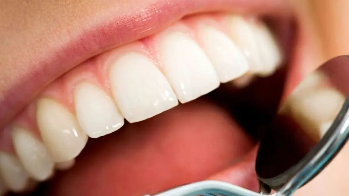پوسیدگی دندان، خطری که از کمبود ویتامین‌ها می‌آید!