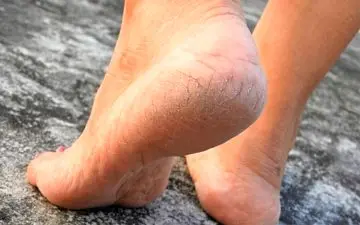 ترک پاشنه پا به کمبود ویتامین خاصی مرتبط است؟