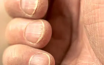 زرد شدن ناخن ها چه علتی دارد؟ |چگونه ناخن های زرد را در خانه سفید کنیم ؟