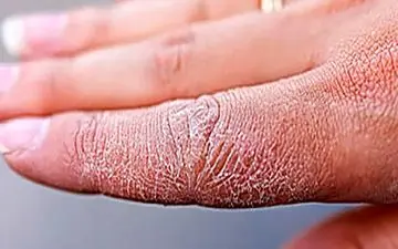 راز خشکی و حساسیت پوست در فصل سرد چیست؟