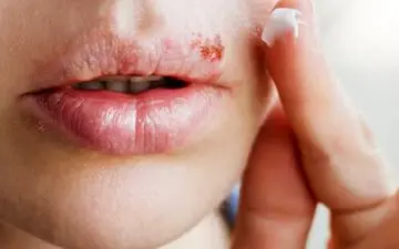 بی حسی یا گزگز لب چقدر جدی است؟

