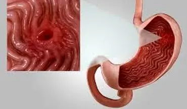 کسانیکه زخم معده دارند حتما این مطلب را بخوانند!