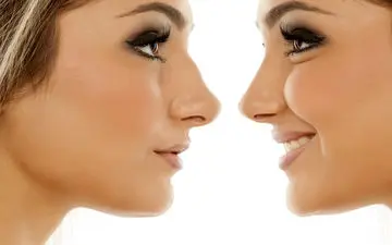 مزایا و معایب جراحی بینی به روش باز