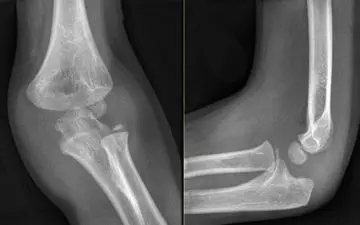 راهکارهایی برای داشتن استخوان‌هایی سالم