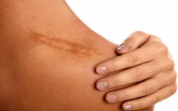  بهترین راهکار‌ها برای درمان و از بین بردن جای زخم در کمترین زمان