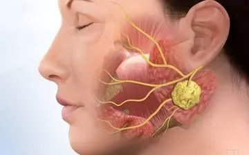 درمان یک سرطان با کشف روشی خاص