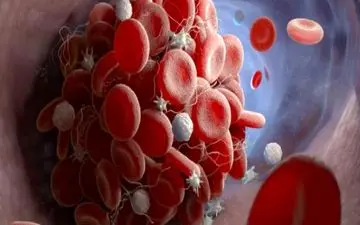 بالا رفتن گلبول های سفید خون به چه علت است؟

