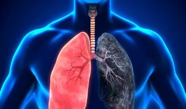 چگونه از خطرات  بیماری ریوی در امان بمانیم؟