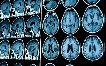 درمان ام.اس ممکن است به یک پروتئین مشکل‌ساز بستگی داشته باشد