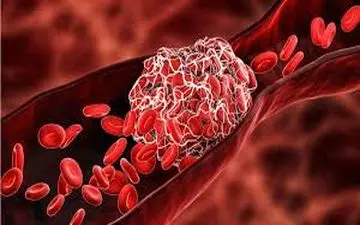  لخته خون در بدن: نشانه‌ها و هشدارهای خطرناک